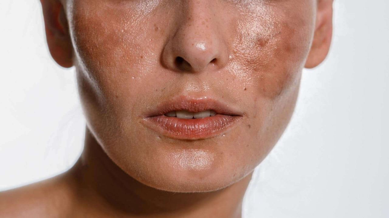 Melasma: All Your Questions Answered Here
