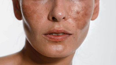 Melasma: All Your Questions Answered Here